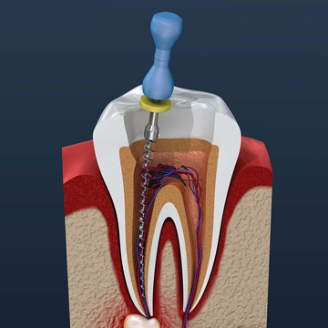 Root Canal Retreatment Explanation