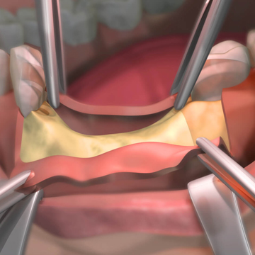 CTG Connective Tissue Graft Dental Procedure