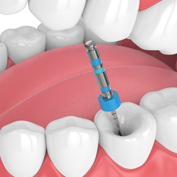 Dental (Oral) Debridement Treatment