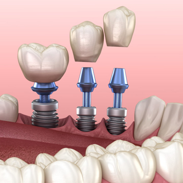 Fixed Partial Denture Over Implant model
