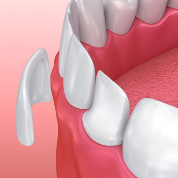 Dental veneers Explanation