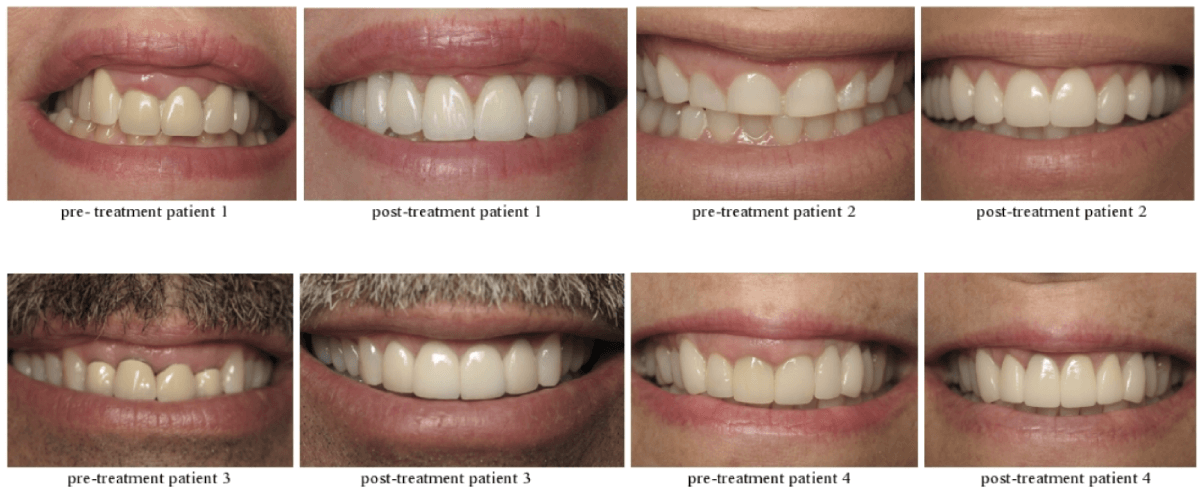 Patients' smiles Before & After Dental Crown Lengthening Surgery at Designer Smiles FL