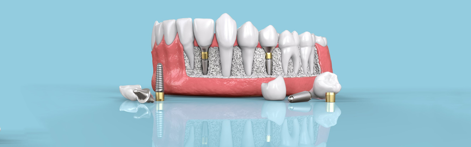 Dental Implants Aftercare Tips from a Dentist