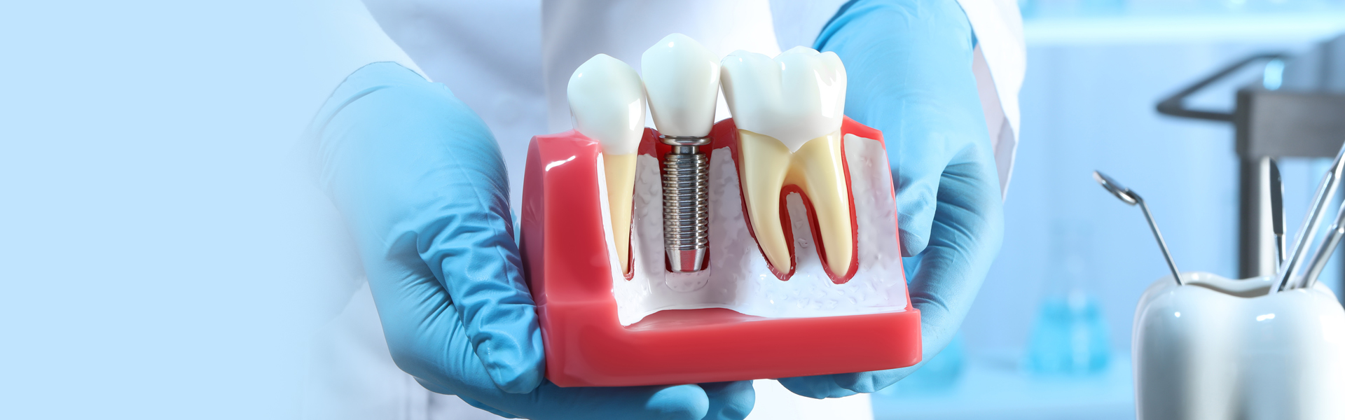 What is a Bridge over Implants, Its Procedure and Benefits
