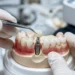 Dental Implant